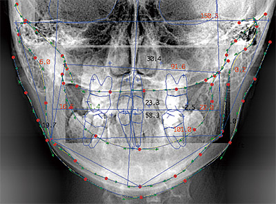 Input frontal line with point mode