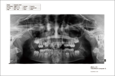 panorama X rays 