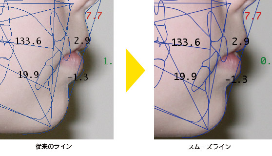 ラインのアンチエイリアス化