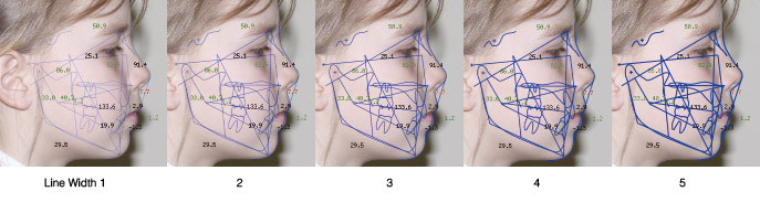 Trace Lien width 