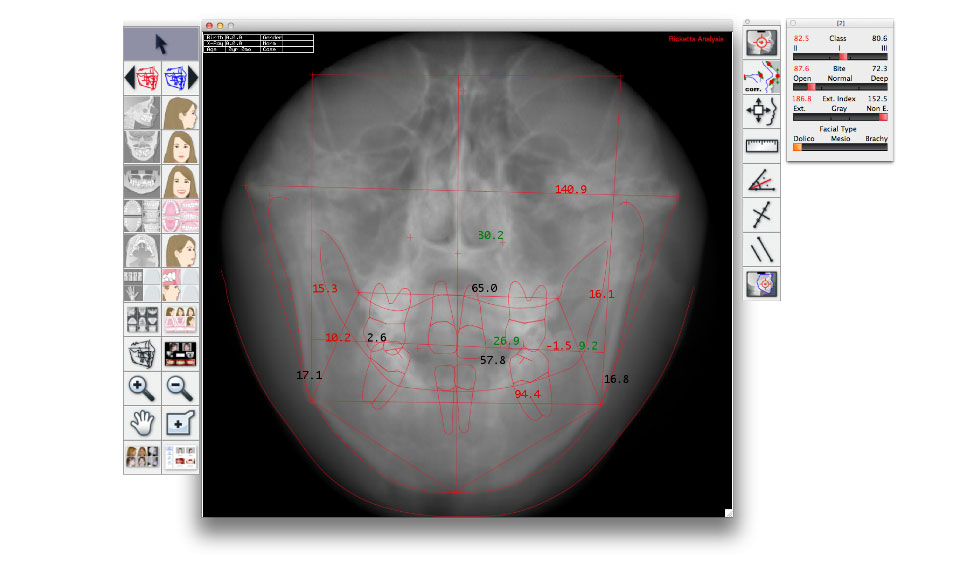 CephaloMetrics AtoZ Ver.16.5