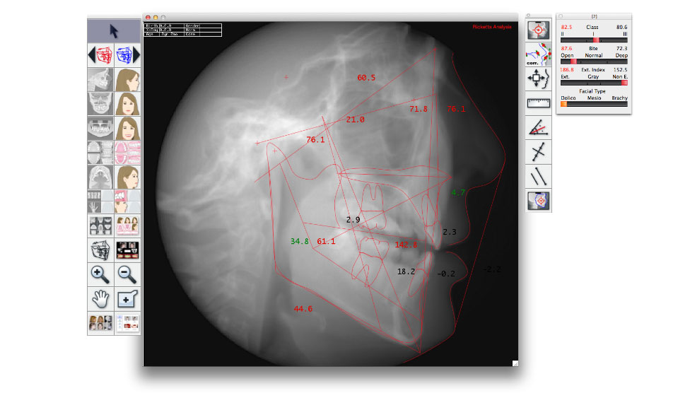 CephaloMetrics AtoZ Ver.16.5