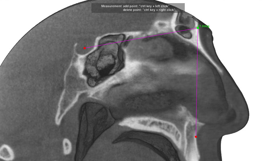 CephaloMetrics AtoZ Ver.16.5