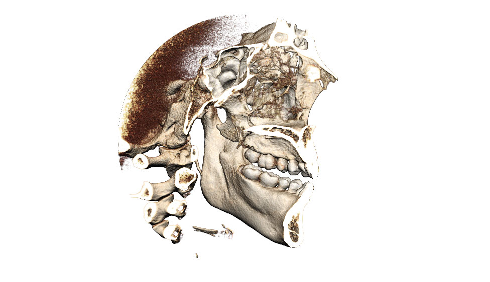 CephaloMetrics AtoZ Ver.16.5