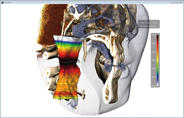 airway