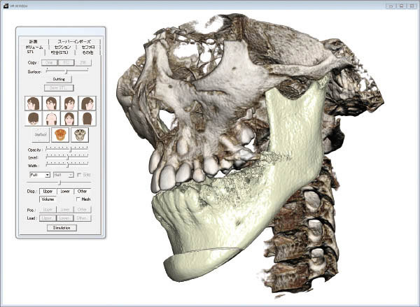 骨切りシミュレーション