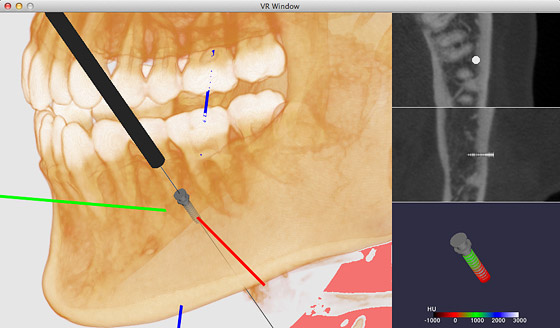 Orthodontic miniscrew simulation