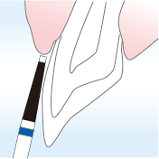 歯茎のラインを保護するための基底部形成