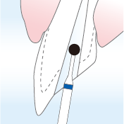 痛んでいる、または腫大した内部を削る