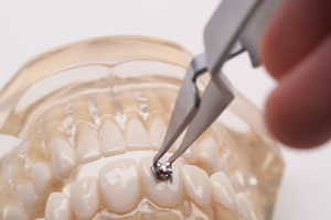 For applying brackets