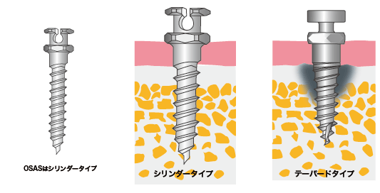 シリンダータイプとテーパードタイプ