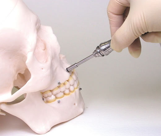 OSAS Driver Tip, 40mm