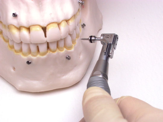 OSAS Contra Angle Tip, 5mm