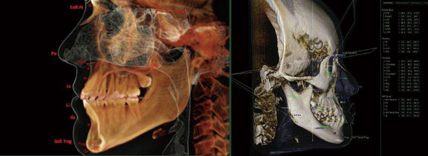 3D Cephalometric Analysis