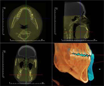 3d surgery cit superimposition