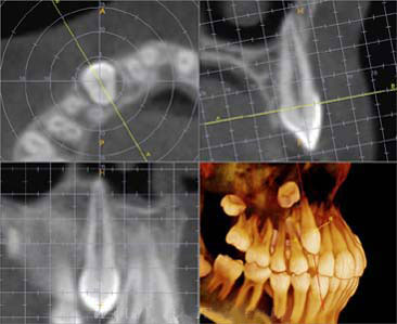 3D canine impaction ct