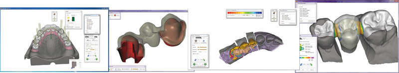 Dental CAD